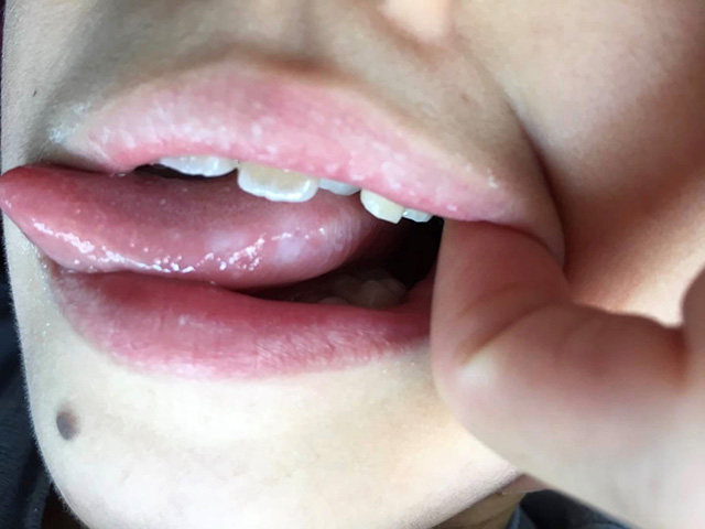 舌にできた口内炎